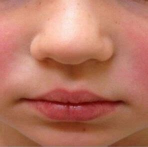 Infektivni eritem | Pedijatrija Dečji svet | Pedijatar Voždovac