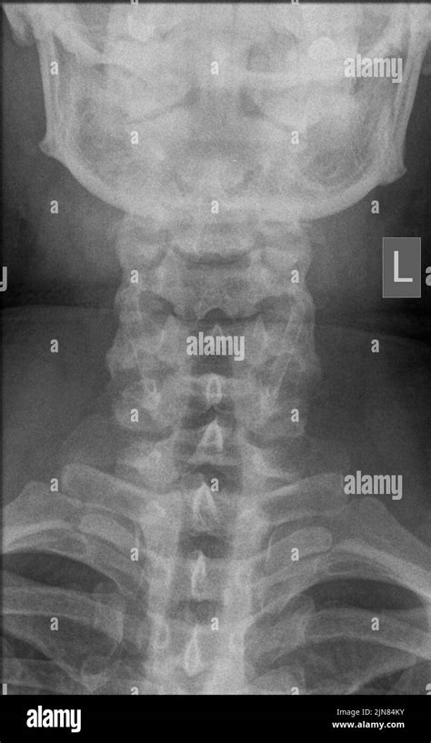Cervical spine, X-ray Stock Photo - Alamy