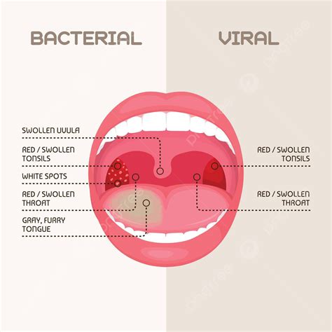 Uvula Inflammation