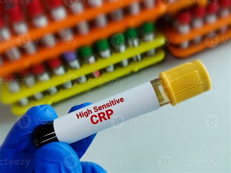 Blood sample tube for hs-CRP or high sensitive CRP test, for the ...