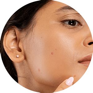 Kapiva Acne Control Kit for - Moderate Acne | Natural Skin Care