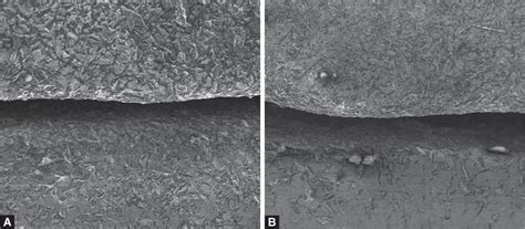 Vertical Marginal Discrepancy of Retrievable Cement/Screw-retained ...