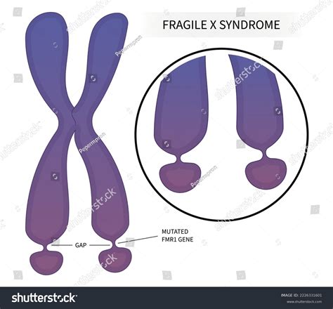 Dna Disorder Testing Fragile X Syndrome Stock Vector (Royalty Free ...