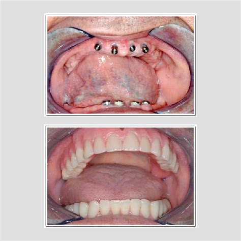 Best Dental implants in noida| Near me