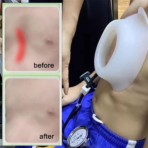 Exemic Pectus Excavatum Vacuum Bell - Pectus Excavatum India | Ubuy