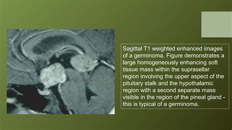 Pituitary gland MRI | PPTX