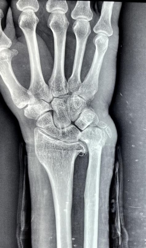 Ulnar Impaction syndrome. : r/Radiology