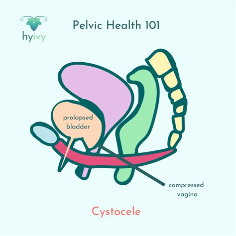 Your Trusted Resource for Common Pelvic Health Terms | Hyivy