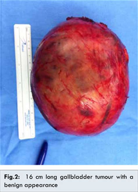 Acute Presentation of Gallbladder Carcinosarcoma and Management