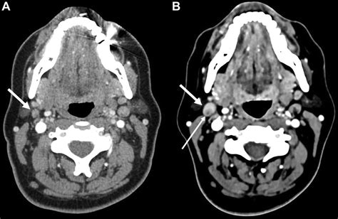Lymph Node Dissection | Radiology Key
