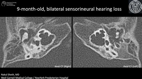 Bilateral Sensorineural Hearing Loss