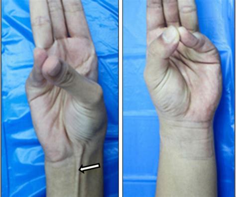 Palmaris Longus Muscle Test Palpable Anatomy: The Palmaris Longus