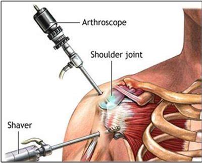 Image result for Post Rotator Cuff Surgery