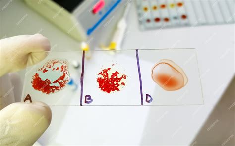Premium Photo | Ab negative rare blood group testing by slide agglutination