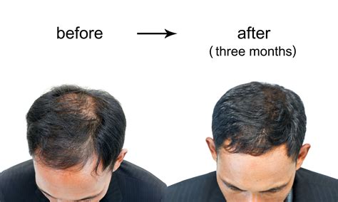 Best Hair Loss Treatments for Men - Hair & Skin Science