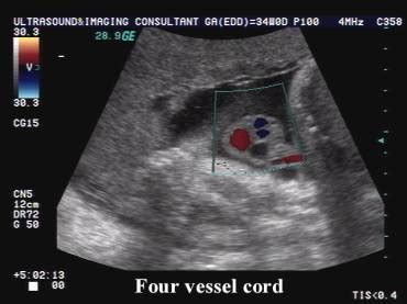 Bildergebnis für 2 vessel umbilical cord ultrasound