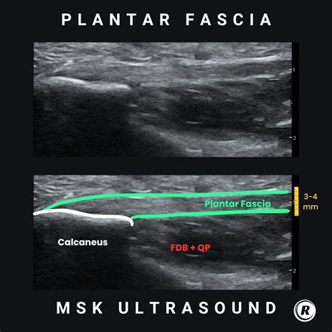 What is the normal thickness of plantar fascia on msk ultrasound? - Rita Chorba, DPT