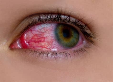 How to Care for a Broken Blood Vessel in the Eye (Subconjunctival Hemorrhage) - Doctronic
