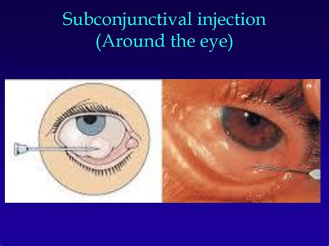 Subconjunctival Injection 的图像结果
