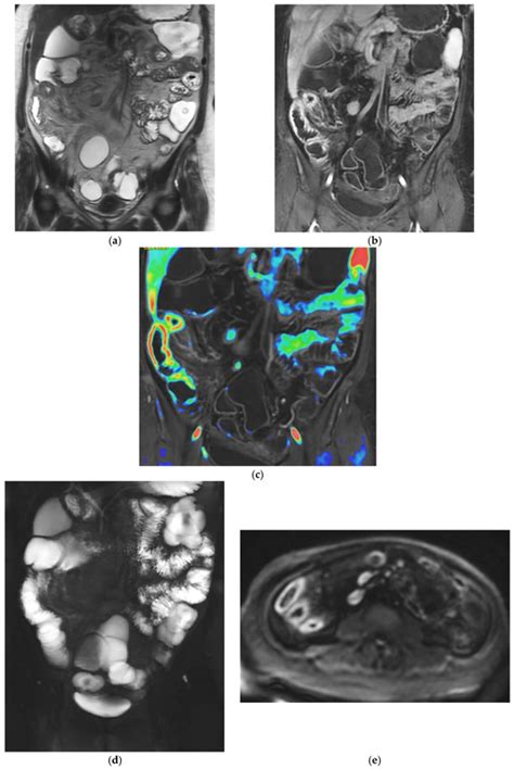 Comprehensive Imaging Evaluation and Staging of Crohn’s Disease: When ...