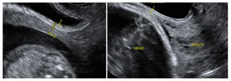 Cesarean Scar Thickness Decreases during Pregnancy: A Prospective ...