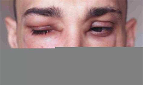 Donidalorsen- new drug for Hereditary Angioedema, reveals phase 3 study
