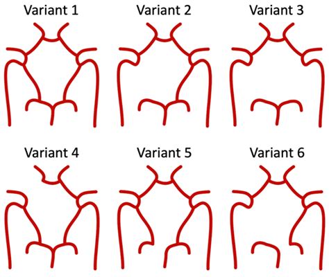 Missing Posterior Communicating Artery
