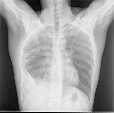 Chest Xray Masks and Labels - Dataset Ninja