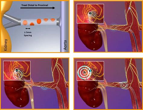 Renal Denervation for Hypertension | JACC: Cardiovascular Interventions
