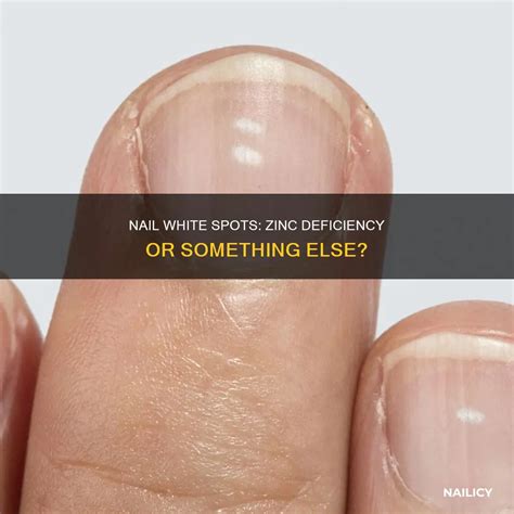 Nail White Spots: Zinc Deficiency Or Something Else? | Nailicy
