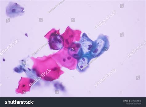 Epithelial Cells Abnormal Pap