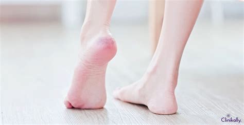 How to Fix Cracked Heels Permanently | Clinikally