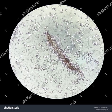 Microscopic Urine Examination Showing Granular Cast Stock Photo ...