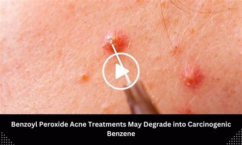 Benzoyl Peroxide Acne Treatments May Degrade into Carcinogenic Benzene ...