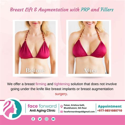 Non Surgical Breast Lift Before And After