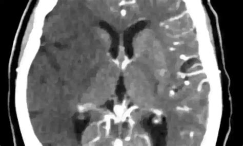 Early CTA imaging benefits patients with transient ischemic attack: Study