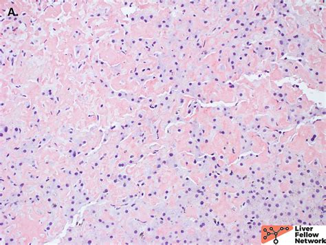 Pathology Pearls: Amyloidosis | AASLD