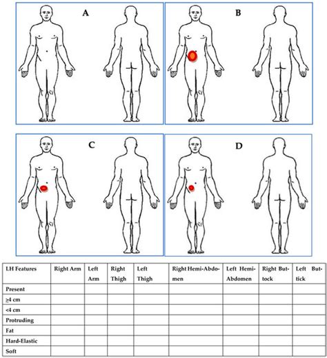 A Neglected Complication of Insulin Therapy Due to Errors in Injection ...