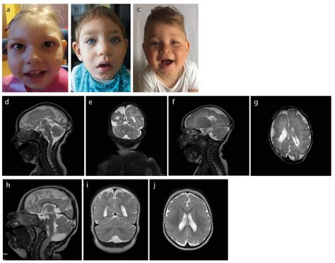 Further Delineation of Phenotype and Genotype of Primary Microcephaly ...