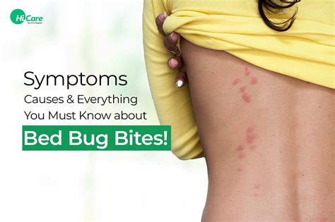 Bed Bugs: How To Identify Bed Bug Bites And Treat Itchy Symptoms – VVSRPO