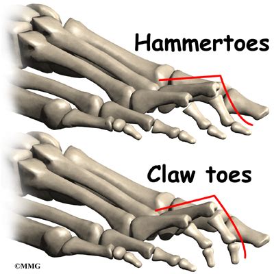 https://www.eorthopod.com/images/ContentImages/foot/foot_claw/foot_clawtoes_anat03.jpg