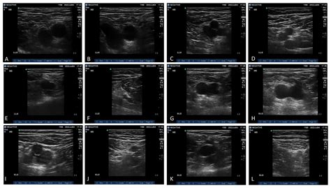 Superficial Femoral Vein Ultrasound