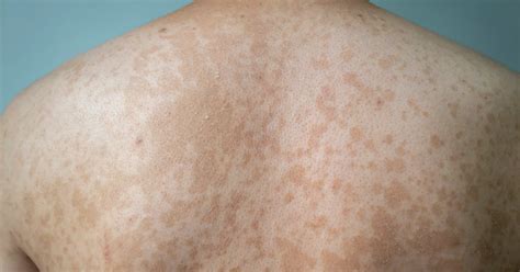 What is tinea versicolor? | Virtuwell