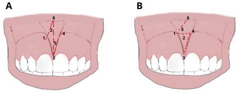 Laser Surgical Approach of Upper Labial Frenulum: A Systematic Review