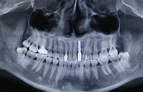 上下颌3—3全瓷冠美容修复一例-guojianhua001的博客-KQ88口腔博客