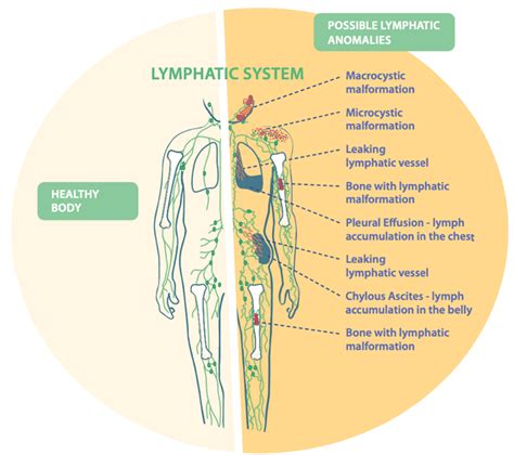 Image result for Lymphatic System Disorders