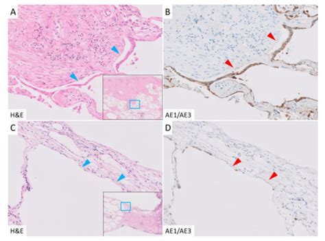 Alveolar Epithelial Denudation Is a Major Factor in the Pathogenesis of ...