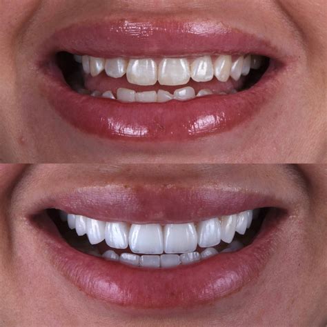 Gallery: Before and After Dental Veneers in Los Angeles, CA | Smiles By Dr. P