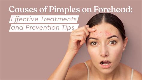 Causes of Pimples on Forehead: Effective Treatments and Prevention Tips