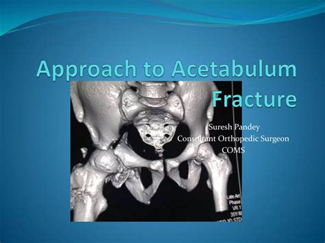 Approach to acetabulum fracture zoom 2020 | PPTX